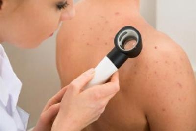 Dermoskopija u Ordinaciji Đukić - proverite sve mladeže na vreme za 2000 din