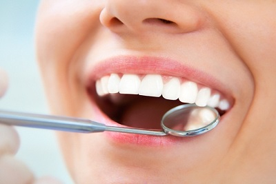 Kamenac, poliranje i fluorizacija zuba.Popuust